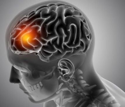 Waspada 5 Jenis Disabilitas yang dimaksud digunakan Sering Dialami Pasien Stroke
