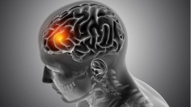 Waspada 5 Jenis Disabilitas yang dimaksud digunakan Sering Dialami Pasien Stroke